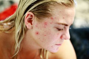 Pflege der unreinen Haut? Geprüfte Methoden in Reichweite